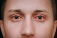 Allergie occhi: cause e rimedi