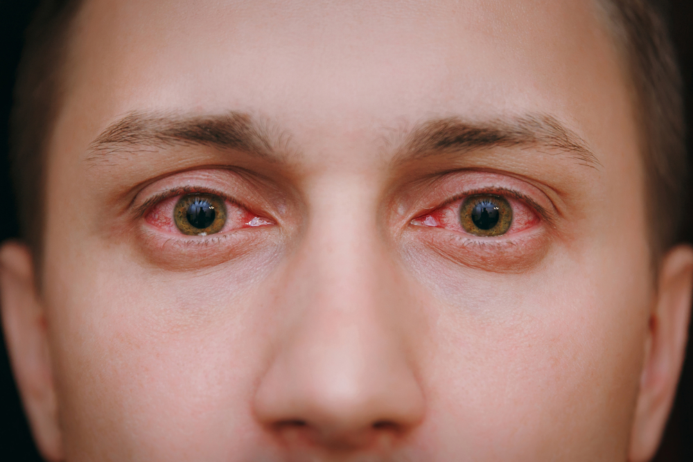allergie agli occhi cause e rimedi
