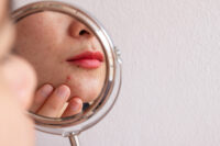 La vitamina A fa bene all’acne?