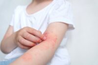 Dermatiti: cause, rimedi e complicazioni