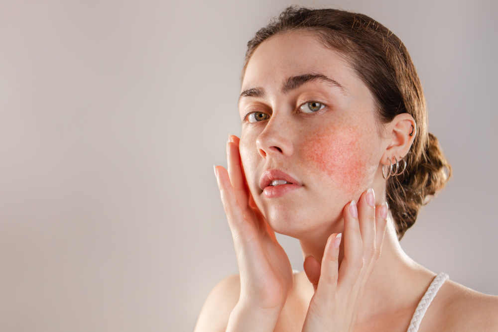 rosacea