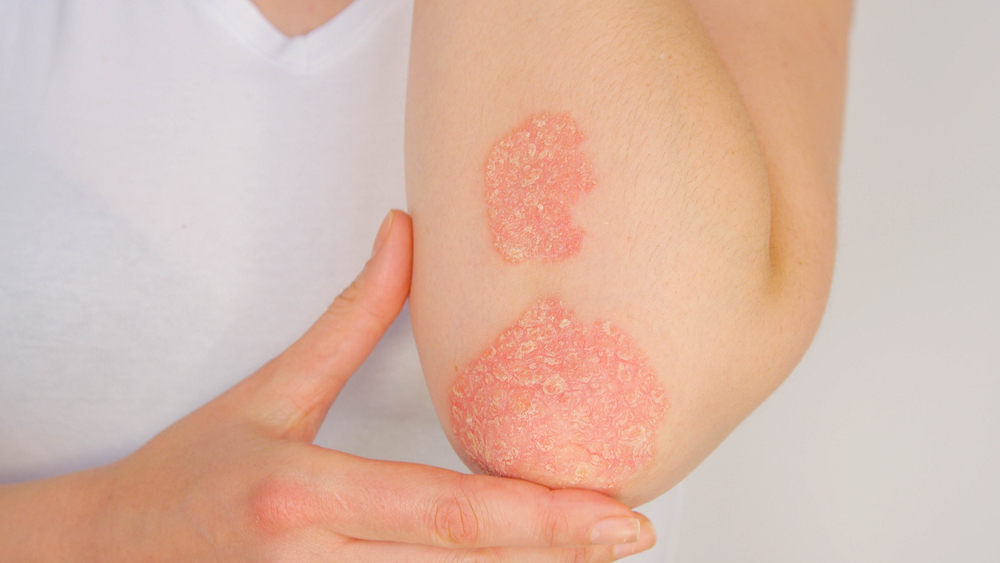 psoriasi